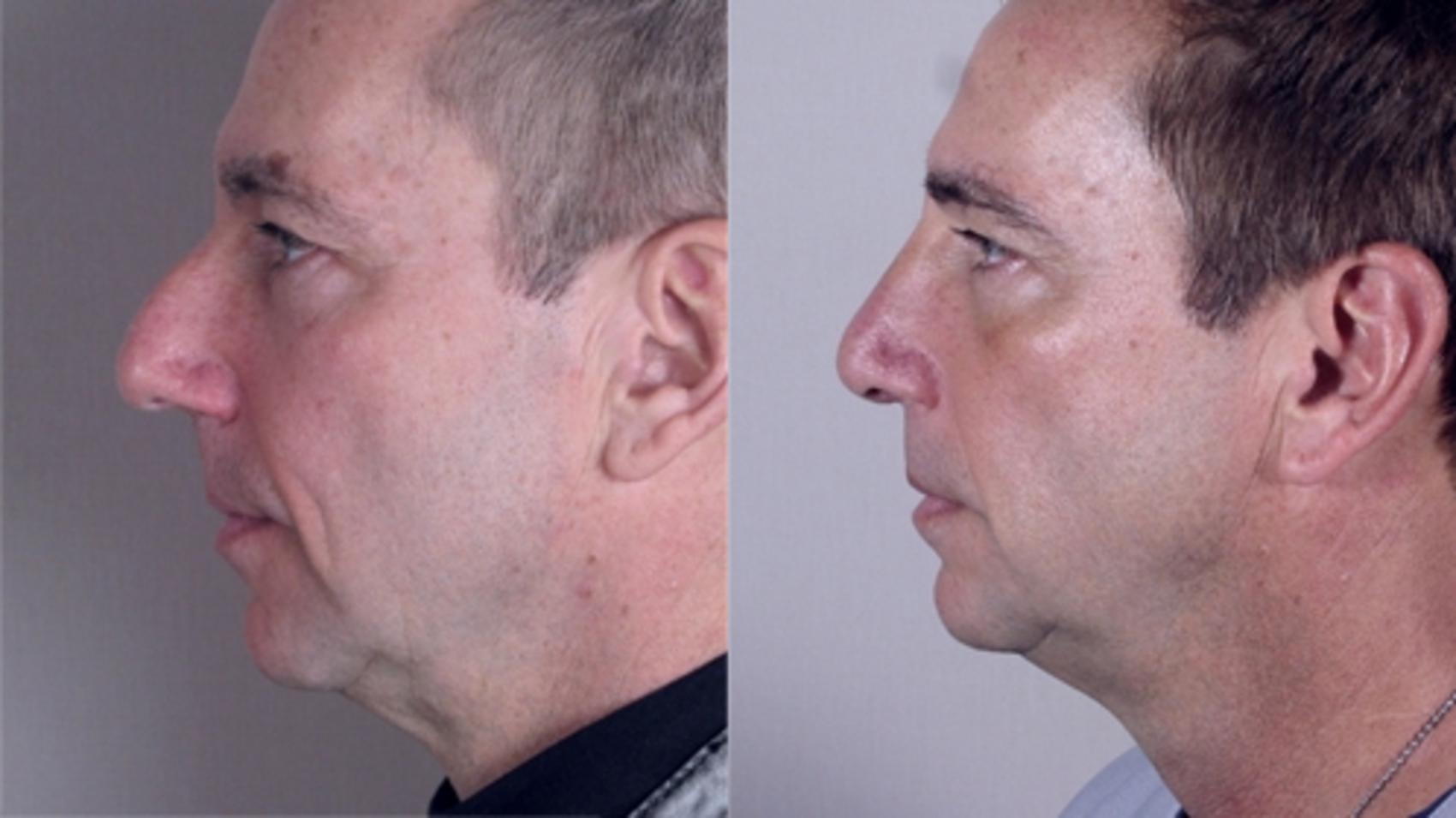 Rhinoplasty Case 146 Before & After View #2 | Paramus, NJ | Parker Center for Plastic Surgery