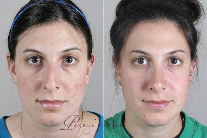 Rhinoplasty Case 147 Before & After View #1 | Paramus, NJ | Parker Center for Plastic Surgery