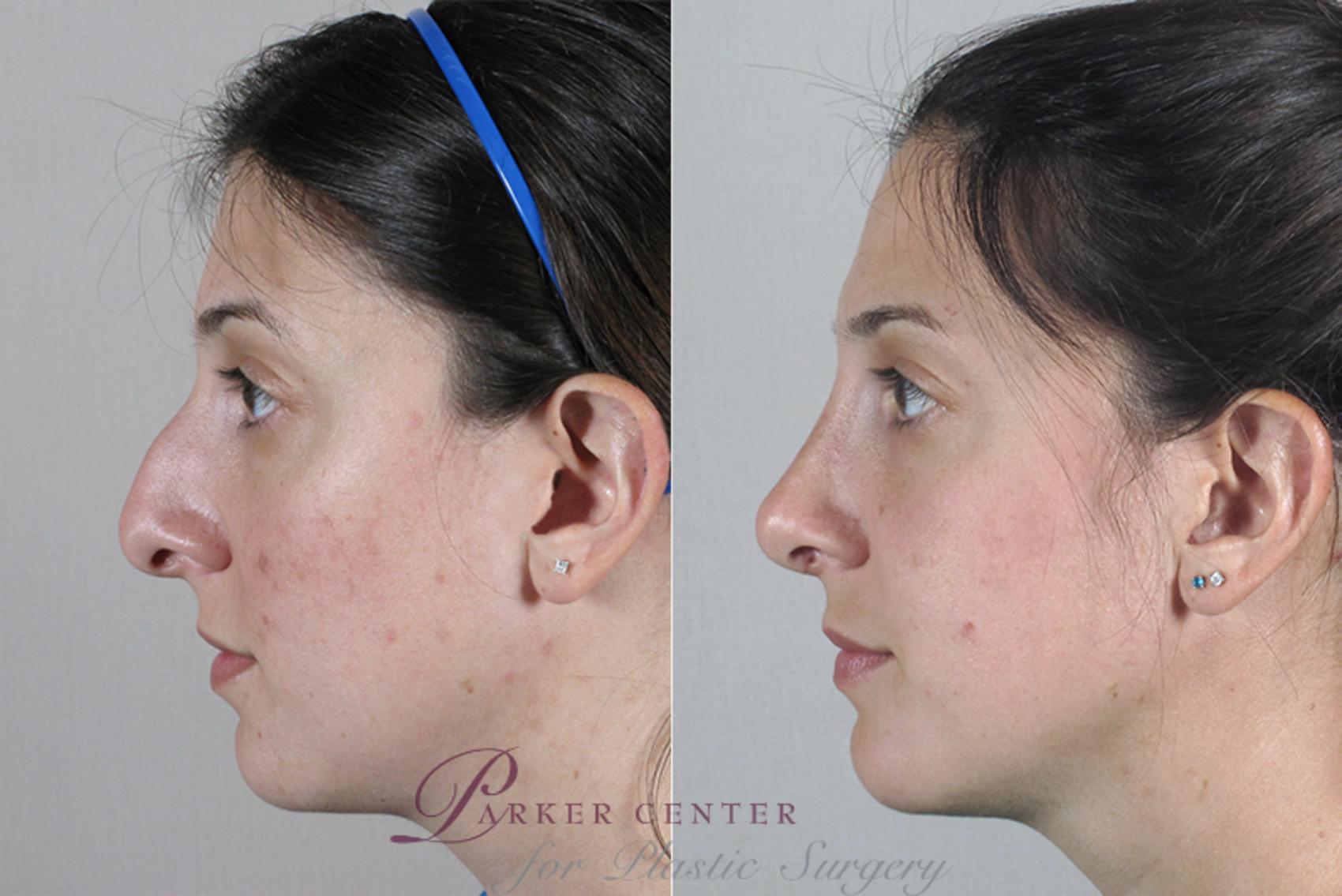 Rhinoplasty Case 147 Before & After View #2 | Paramus, NJ | Parker Center for Plastic Surgery