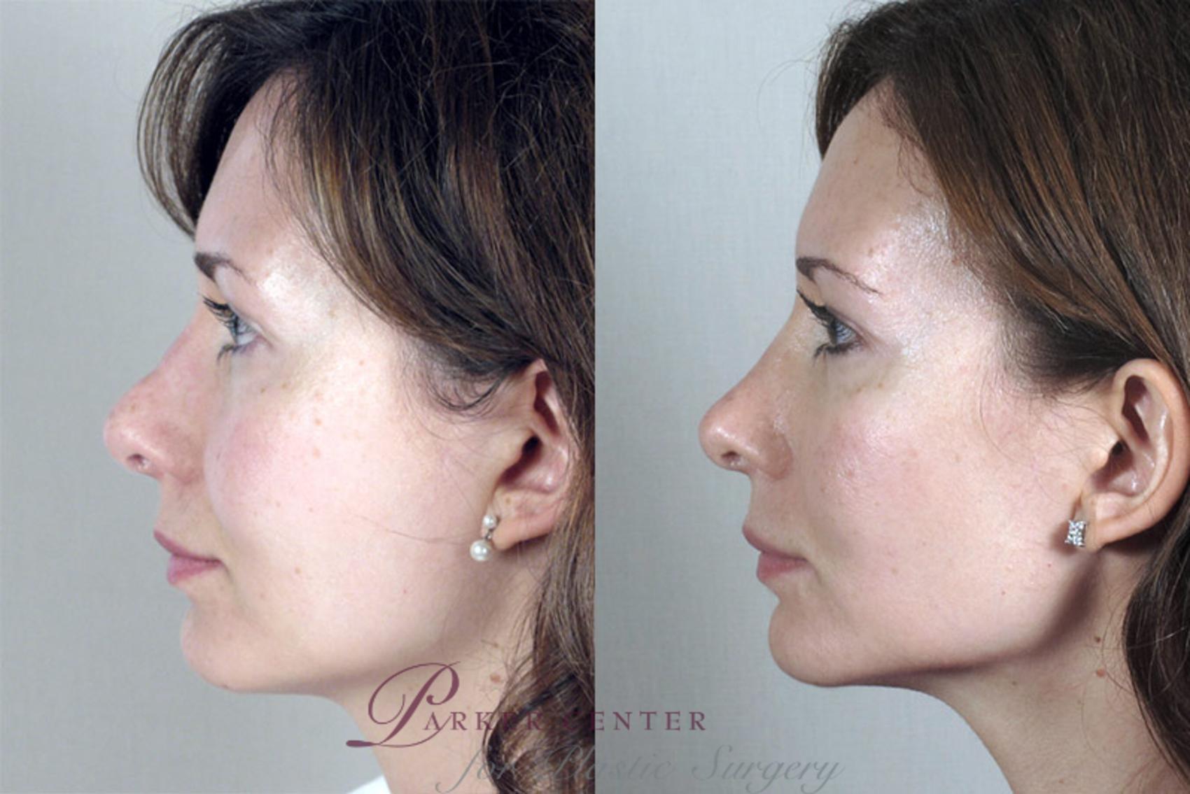 Rhinoplasty Case 148 Before & After View #2 | Paramus, NJ | Parker Center for Plastic Surgery
