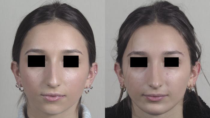 Rhinoplasty Case 1480 Before & After Front | Paramus, New Jersey | Parker Center for Plastic Surgery