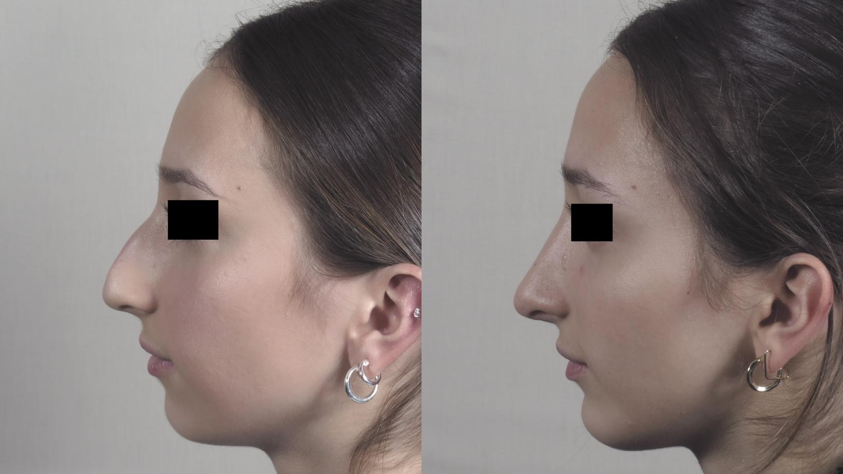 Rhinoplasty Case 1480 Before & After Left Side | Paramus, New Jersey | Parker Center for Plastic Surgery