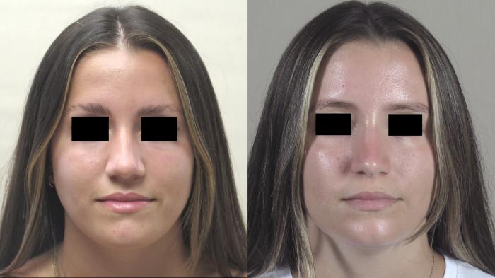 Rhinoplasty Case 1488 Before & After Front | Paramus, New Jersey | Parker Center for Plastic Surgery