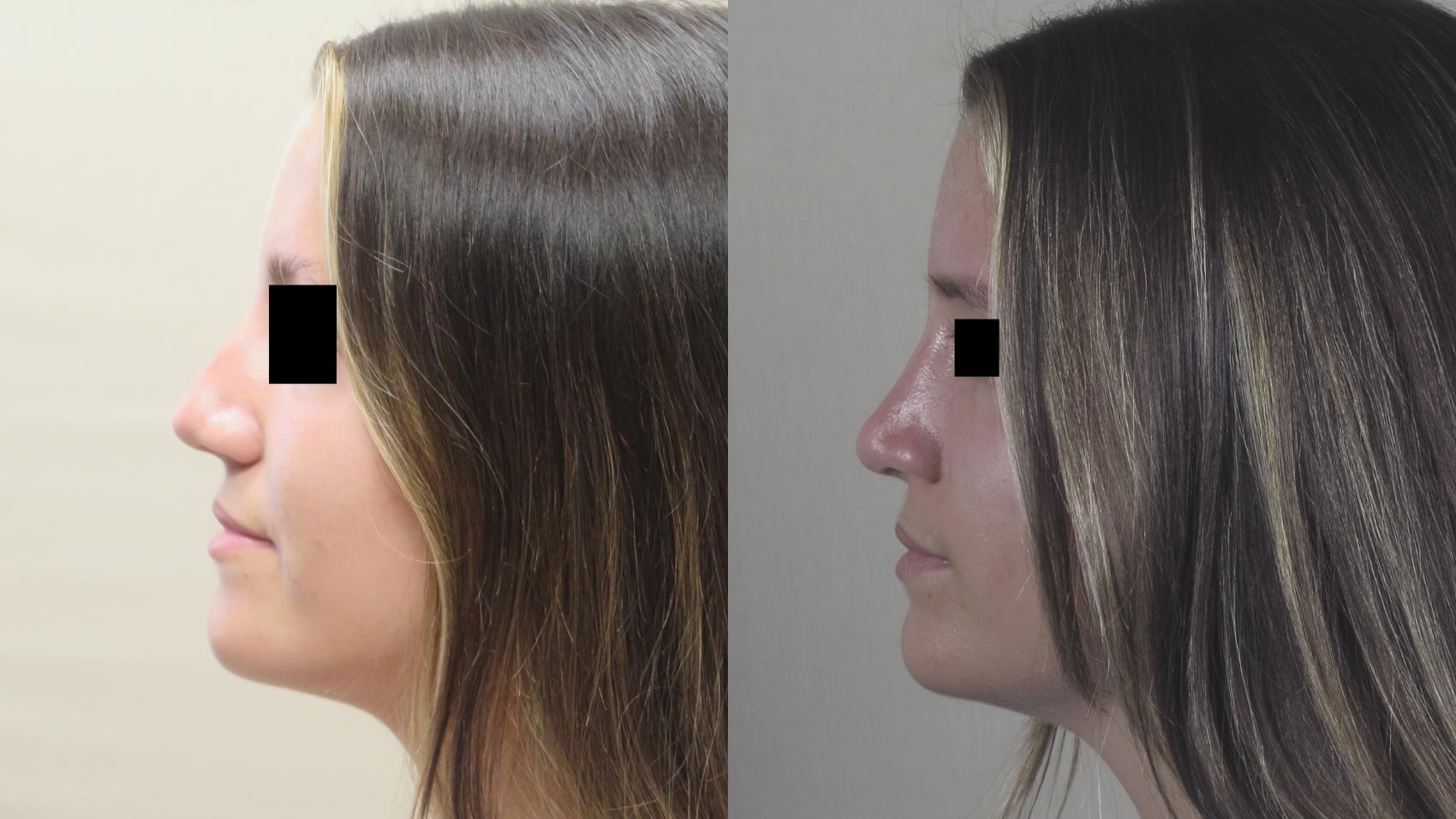 Rhinoplasty Case 1488 Before & After Left Side | Paramus, New Jersey | Parker Center for Plastic Surgery