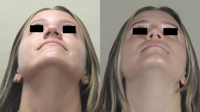 Rhinoplasty Case 1488 Before & After Worm's | Paramus, New Jersey | Parker Center for Plastic Surgery