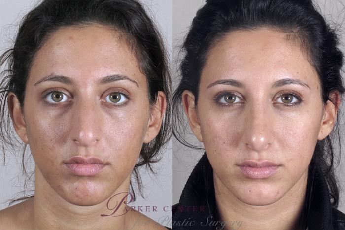 Rhinoplasty Case 149 Before & After View #1 | Paramus, NJ | Parker Center for Plastic Surgery