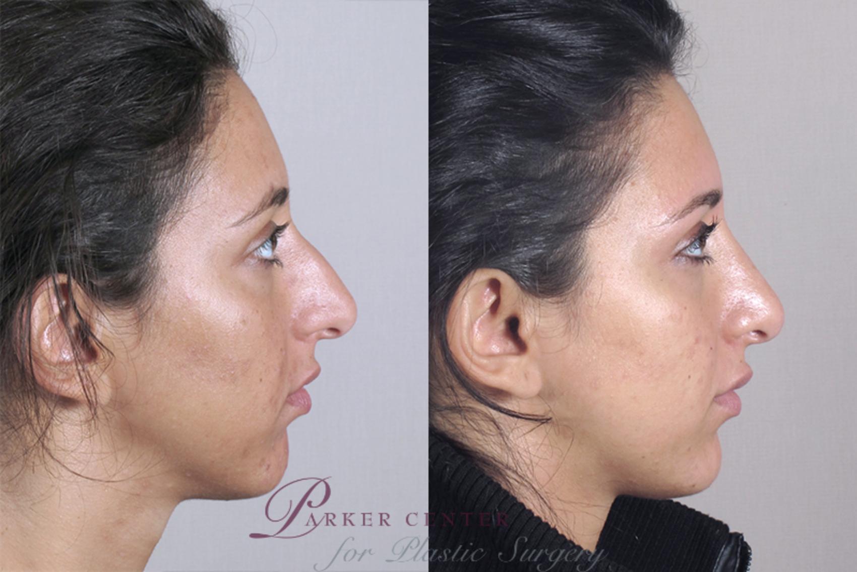 Rhinoplasty Case 149 Before & After View #2 | Paramus, NJ | Parker Center for Plastic Surgery