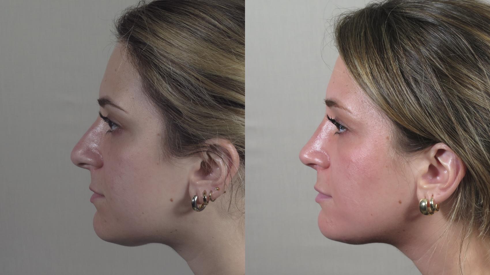 Rhinoplasty Case 1498 Before & After Left Side | Paramus, New Jersey | Parker Center for Plastic Surgery