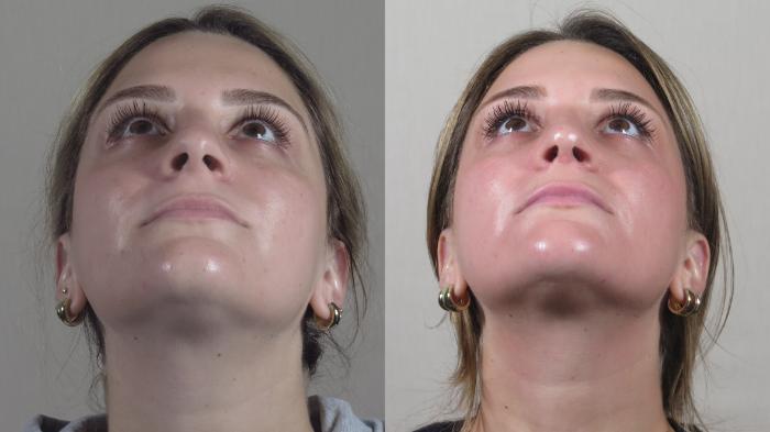 Rhinoplasty Case 1498 Before & After Worm's | Paramus, New Jersey | Parker Center for Plastic Surgery