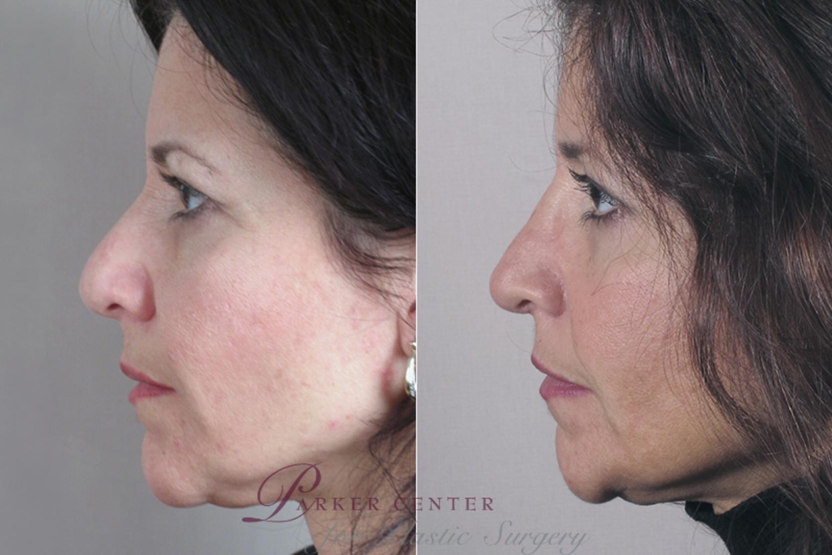 Rhinoplasty Case 150 Before & After View #2 | Paramus, NJ | Parker Center for Plastic Surgery