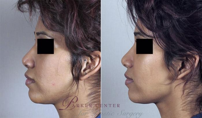 Rhinoplasty Case 151 Before & After View #2 | Paramus, NJ | Parker Center for Plastic Surgery