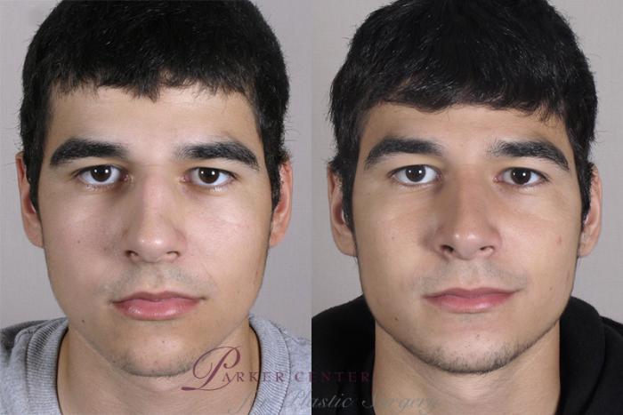 Rhinoplasty Case 152 Before & After View #1 | Paramus, NJ | Parker Center for Plastic Surgery