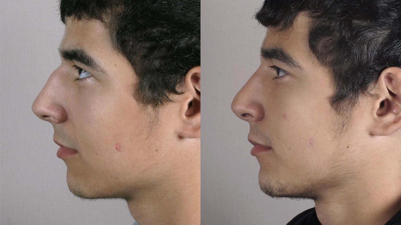 Rhinoplasty Case 152 Before & After View #2 | Paramus, New Jersey | Parker Center for Plastic Surgery