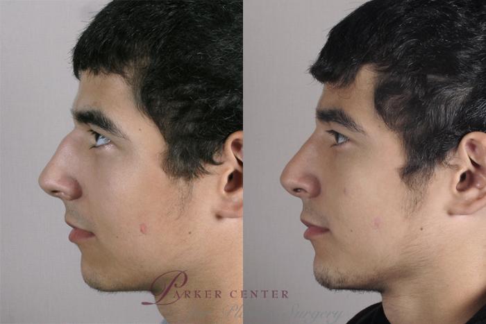 Rhinoplasty Case 152 Before & After View #2 | Paramus, NJ | Parker Center for Plastic Surgery