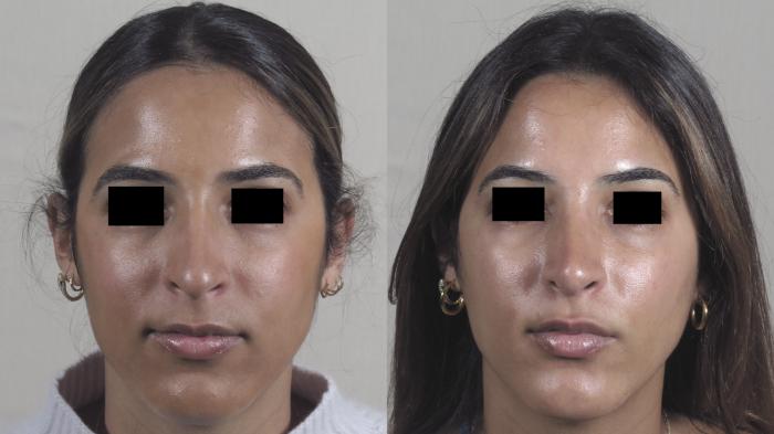 Rhinoplasty Case 1520 Before & After Front | Paramus, New Jersey | Parker Center for Plastic Surgery