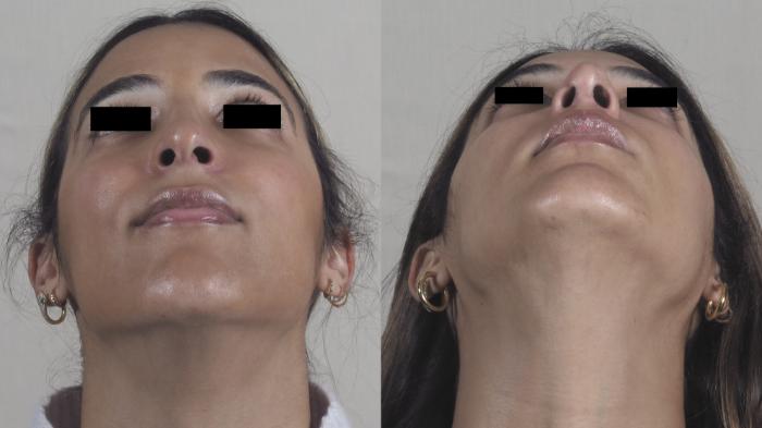 Rhinoplasty Case 1520 Before & After Worms | Paramus, New Jersey | Parker Center for Plastic Surgery