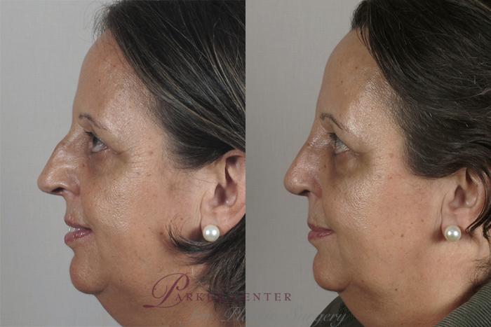 Rhinoplasty Case 153 Before & After View #2 | Paramus, NJ | Parker Center for Plastic Surgery