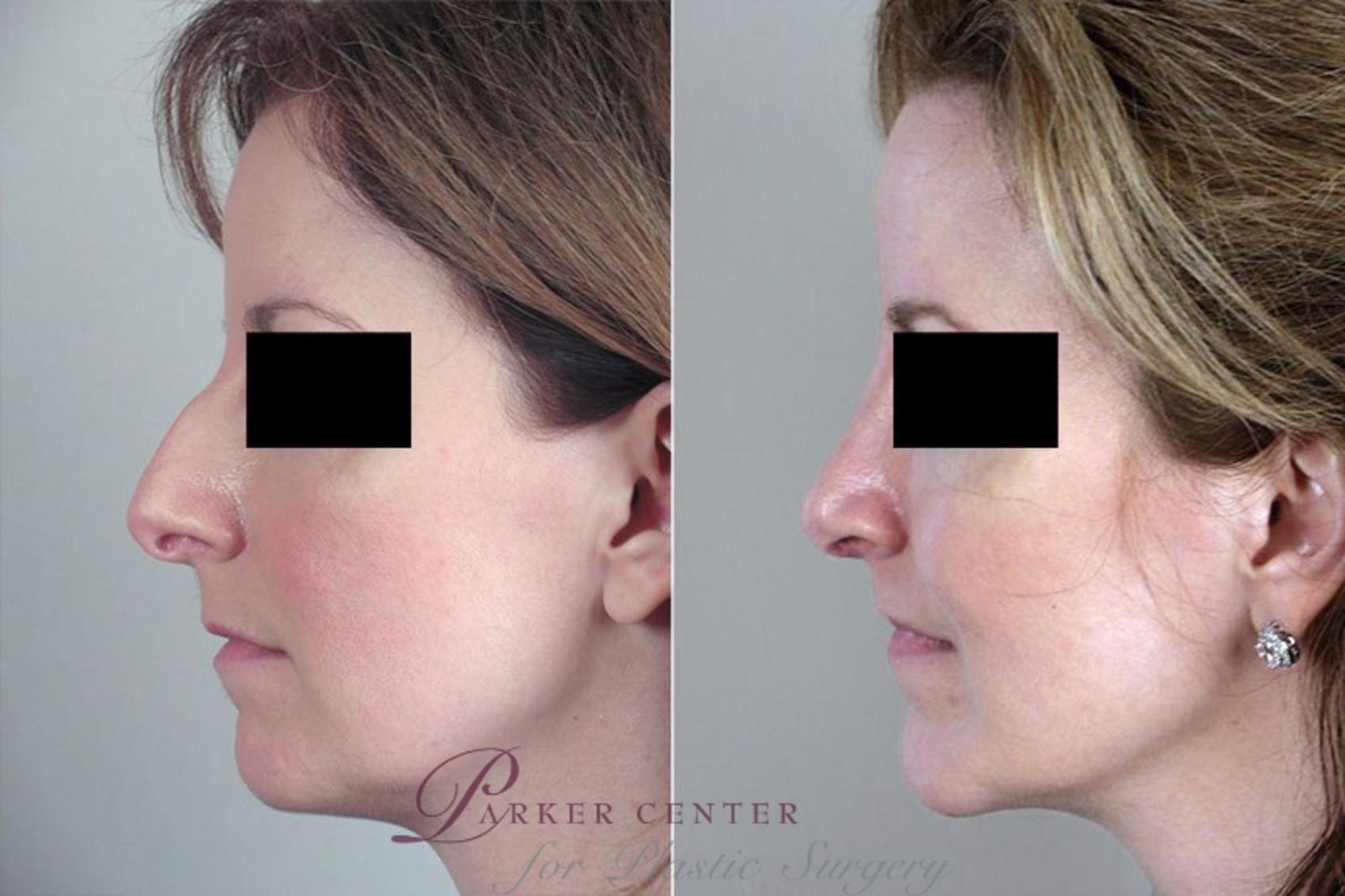 Rhinoplasty Case 154 Before & After View #2 | Paramus, NJ | Parker Center for Plastic Surgery