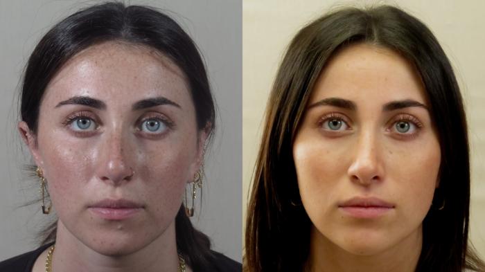 Rhinoplasty Case 1551 Before & After Front | Paramus, New Jersey | Parker Center for Plastic Surgery