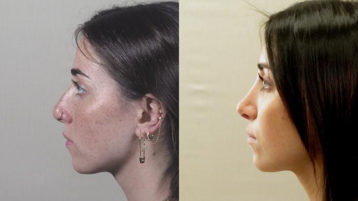 Rhinoplasty Case 1551 Before & After Left Side | Paramus, New Jersey | Parker Center for Plastic Surgery