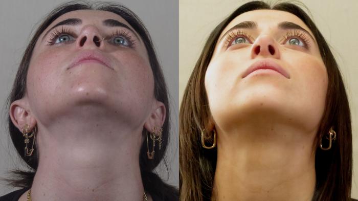 Rhinoplasty Case 1551 Before & After Worn's | Paramus, New Jersey | Parker Center for Plastic Surgery