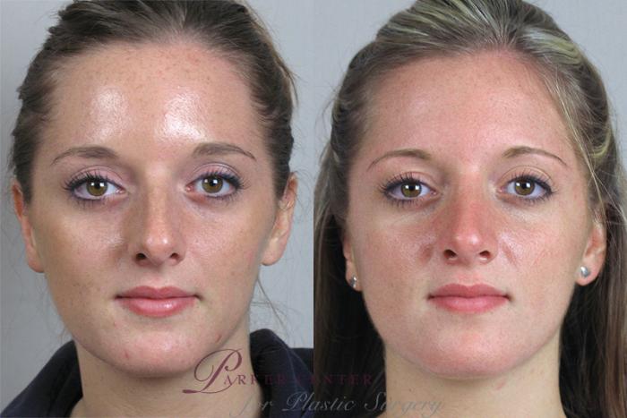 Rhinoplasty Case 156 Before & After View #1 | Paramus, NJ | Parker Center for Plastic Surgery