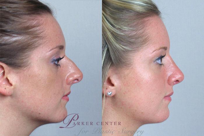Rhinoplasty Case 156 Before & After View #2 | Paramus, NJ | Parker Center for Plastic Surgery