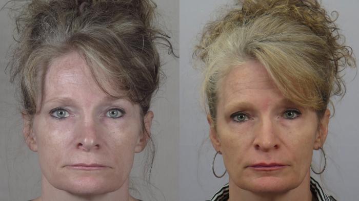 Rhinoplasty Case 1562 Before & After Front | Paramus, New Jersey | Parker Center for Plastic Surgery