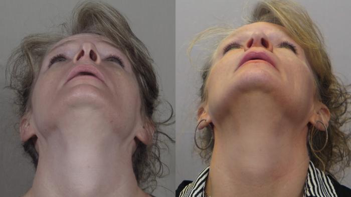 Rhinoplasty Case 1562 Before & After Worms | Paramus, New Jersey | Parker Center for Plastic Surgery