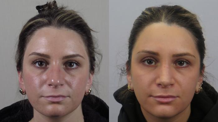Rhinoplasty Case 1569 Before & After Front | Paramus, New Jersey | Parker Center for Plastic Surgery