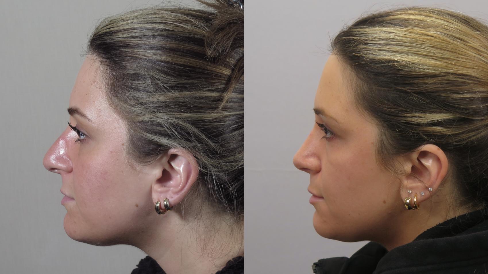 Rhinoplasty Case 1569 Before & After Left Side | Paramus, New Jersey | Parker Center for Plastic Surgery