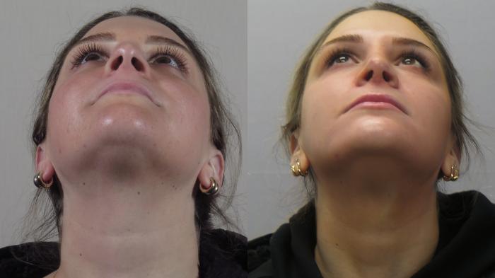 Rhinoplasty Case 1569 Before & After Worm's | Paramus, New Jersey | Parker Center for Plastic Surgery
