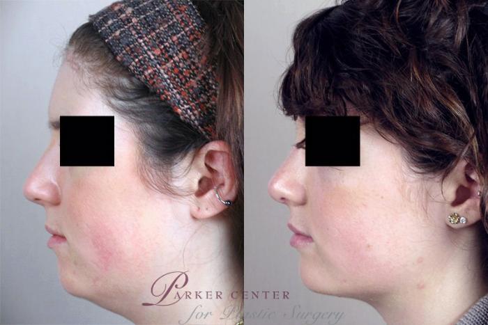 Rhinoplasty Case 157 Before & After View #2 | Paramus, NJ | Parker Center for Plastic Surgery