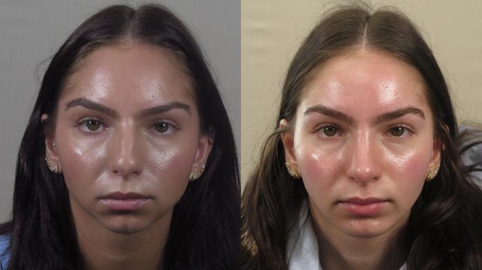 Rhinoplasty Case 1573 Before & After Front | Paramus, New Jersey | Parker Center for Plastic Surgery