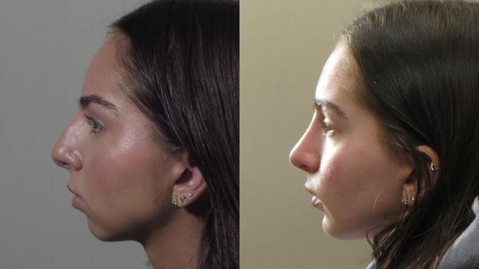 Rhinoplasty Case 1573 Before & After Left Side | Paramus, New Jersey | Parker Center for Plastic Surgery