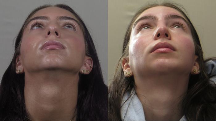 Rhinoplasty Case 1573 Before & After worms | Paramus, New Jersey | Parker Center for Plastic Surgery