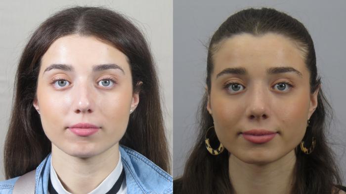 Rhinoplasty Case 1574 Before & After Front | Paramus, New Jersey | Parker Center for Plastic Surgery