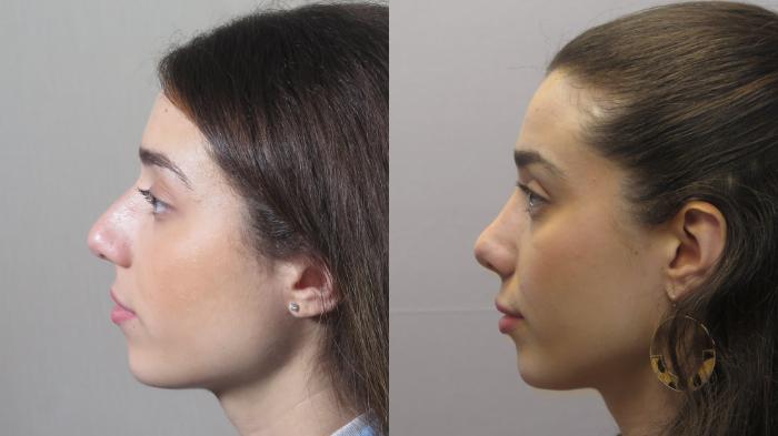 Rhinoplasty Case 1574 Before & After Left Side | Paramus, New Jersey | Parker Center for Plastic Surgery