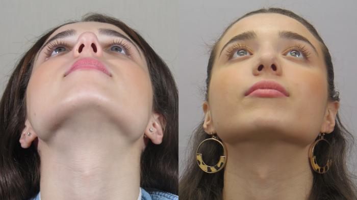 Rhinoplasty Case 1574 Before & After worms | Paramus, New Jersey | Parker Center for Plastic Surgery