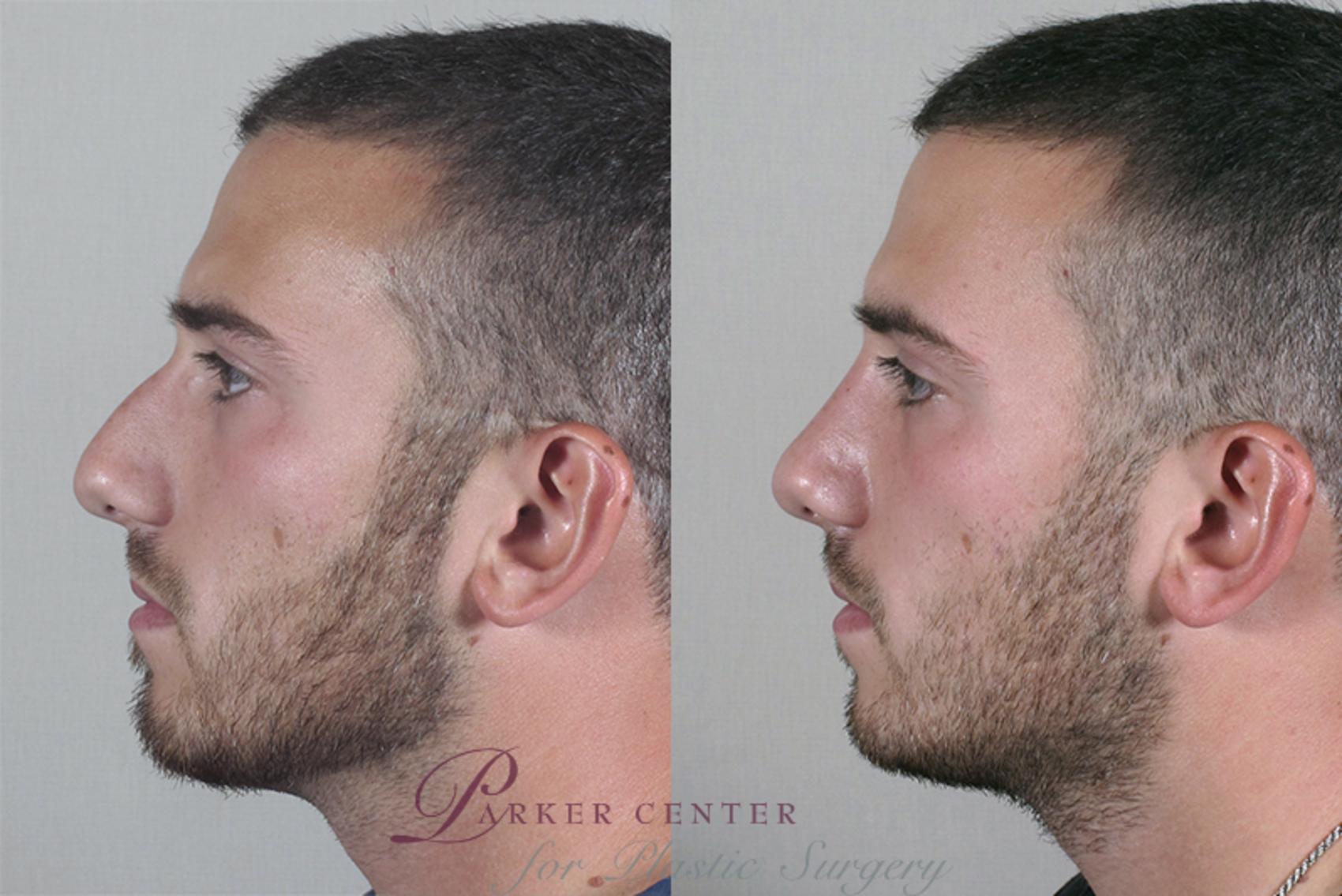 Rhinoplasty Case 158 Before & After View #2 | Paramus, NJ | Parker Center for Plastic Surgery