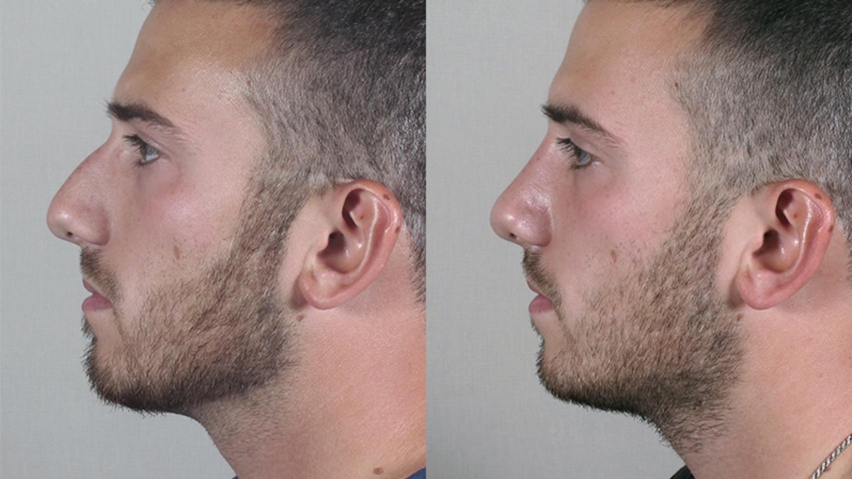 Rhinoplasty Case 158 Before & After View #2 | Paramus, NJ | Parker Center for Plastic Surgery