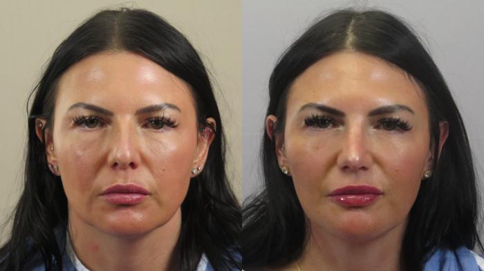 Rhinoplasty Case 1587 Before & After Front | Paramus, New Jersey | Parker Center for Plastic Surgery