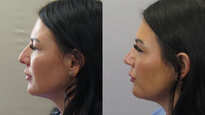 Rhinoplasty Case 1587 Before & After Left Side | Paramus, New Jersey | Parker Center for Plastic Surgery