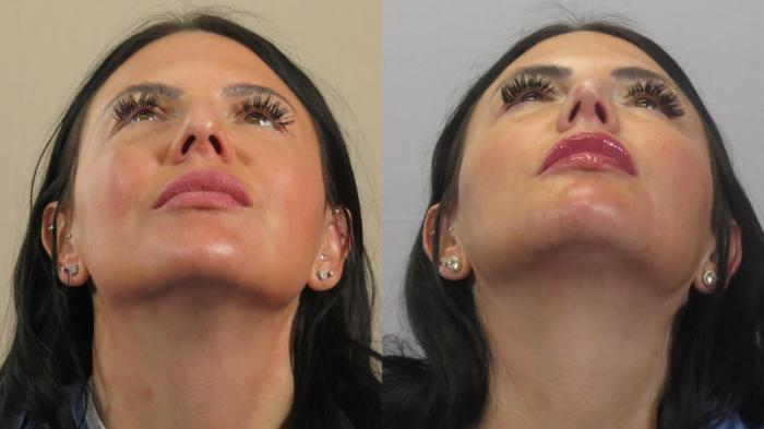 Rhinoplasty Case 1587 Before & After Worm's | Paramus, New Jersey | Parker Center for Plastic Surgery