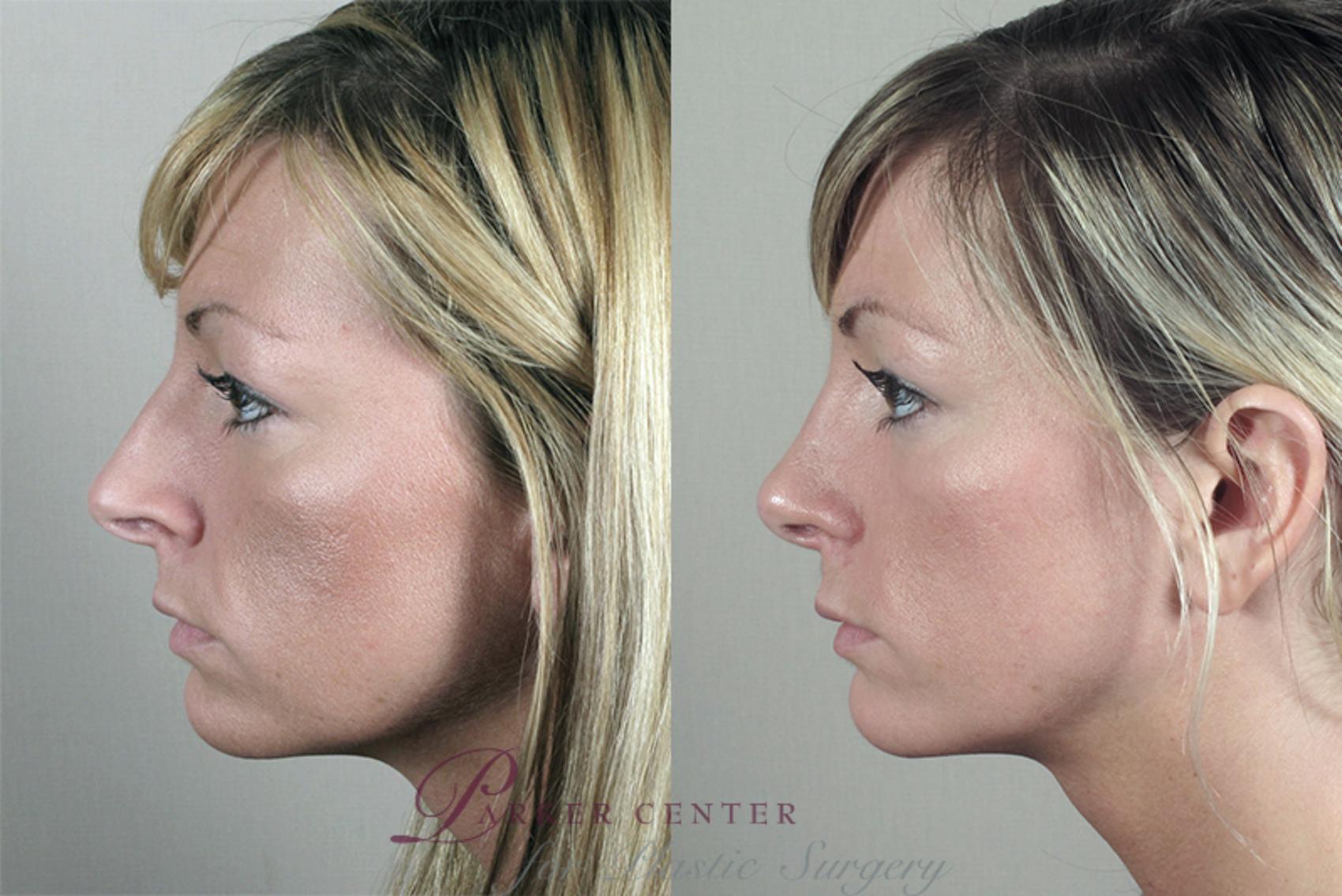 Rhinoplasty Case 159 Before & After View #2 | Paramus, NJ | Parker Center for Plastic Surgery