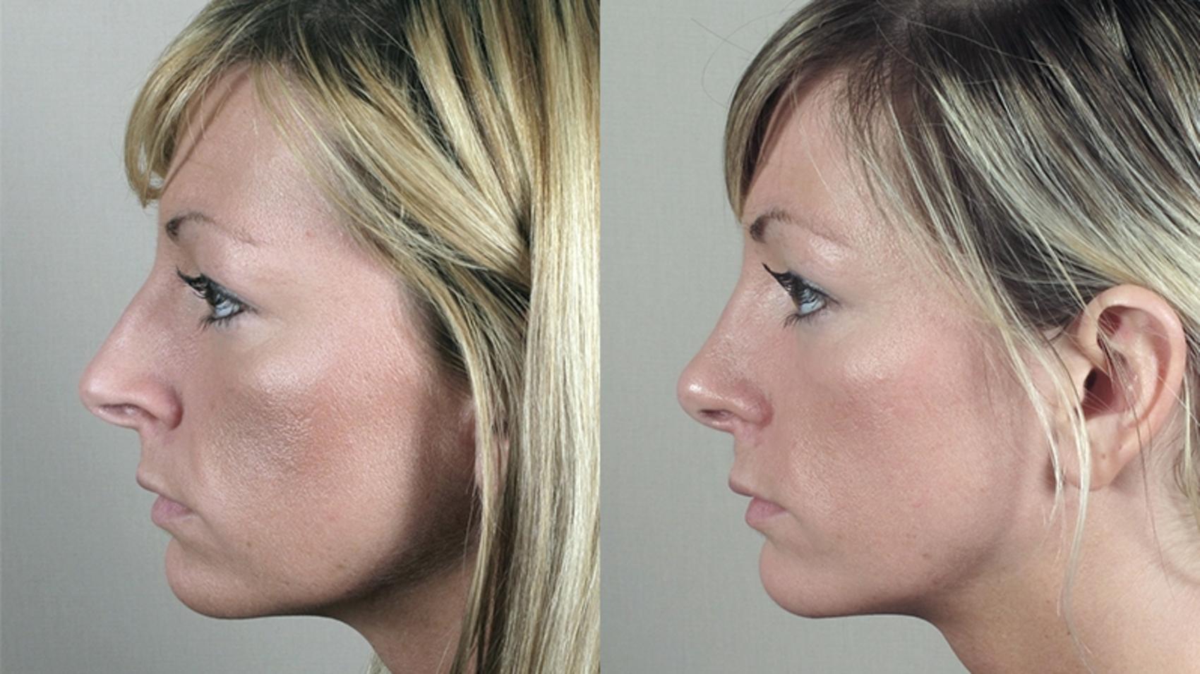 Rhinoplasty Case 159 Before & After View #2 | Paramus, NJ | Parker Center for Plastic Surgery