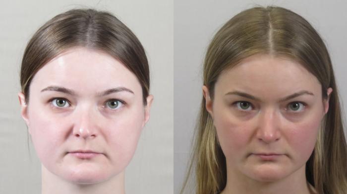Rhinoplasty Case 1590 Before & After Front | Paramus, New Jersey | Parker Center for Plastic Surgery