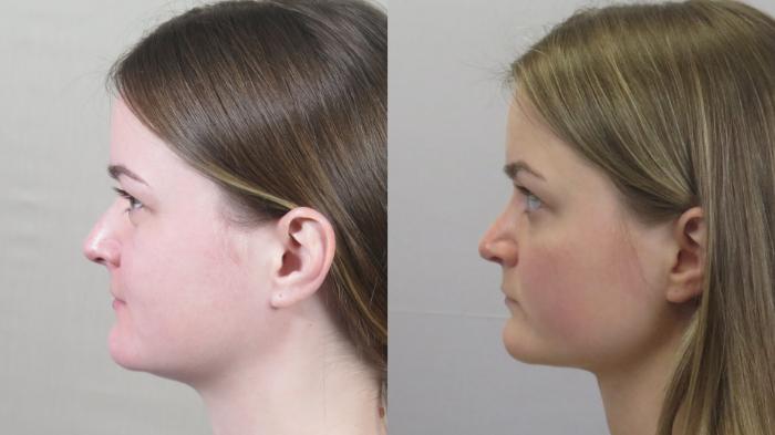 Rhinoplasty Case 1590 Before & After Left Side | Paramus, New Jersey | Parker Center for Plastic Surgery