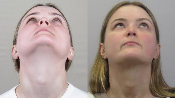 Rhinoplasty Case 1590 Before & After Worm's | Paramus, New Jersey | Parker Center for Plastic Surgery