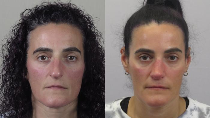 Rhinoplasty Case 1594 Before & After Front | Paramus, New Jersey | Parker Center for Plastic Surgery